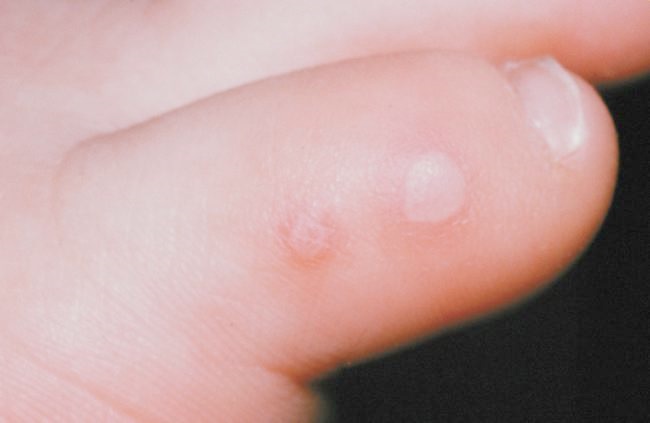image of HFMD lesions - baby toe